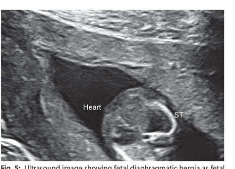 Figure 5 From Ultrasound Detection Of Fetal Structural Anomalies During