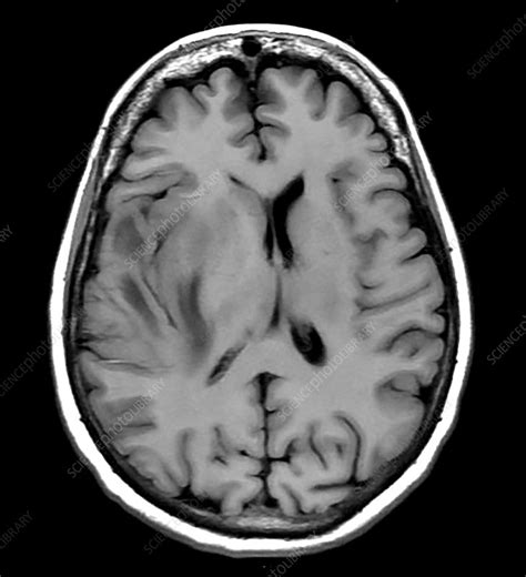 Temporal Glioblastoma MRI Stock Image C039 4147 Science Photo