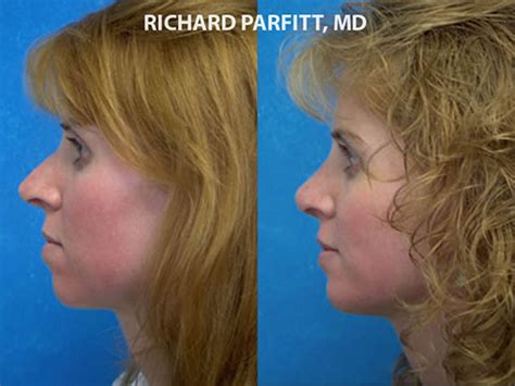 Chin Implants Parfitt Facial Plastic Surgery Center