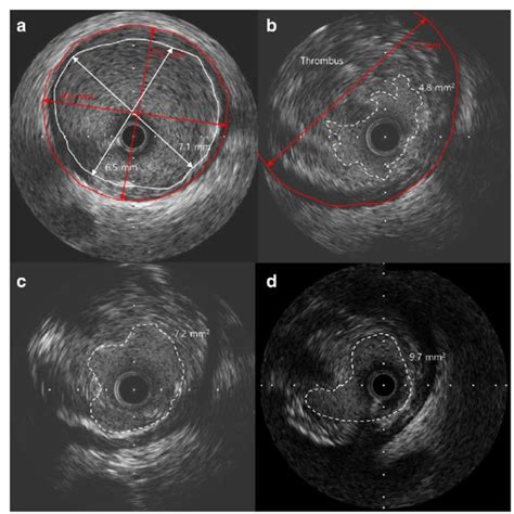 Intravascular Ultrasound Ivus Findings A Adjacent Normal Segment Download Scientific Diagram