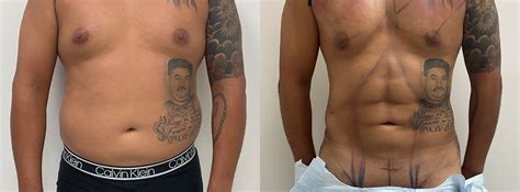 Abdominal Etching Before And After Photos Avana Plastic Surgery