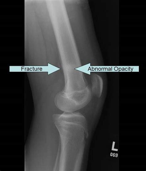 Management Of Knee Ligament Injuries - Introduction to Sports Medicine