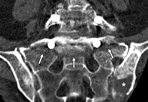 Sacral Fractures After Lumbosacral Fusion A Characteristic Fracture Pattern Ajr