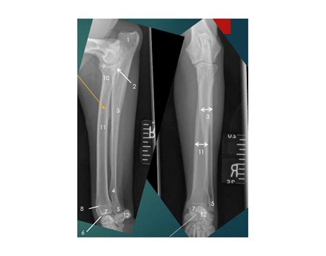 Radius/ulna radiographic anatomy Quiz