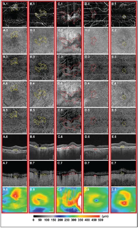 Figure From Ultrahigh Speed Swept Source Oct Angiography In Exudative