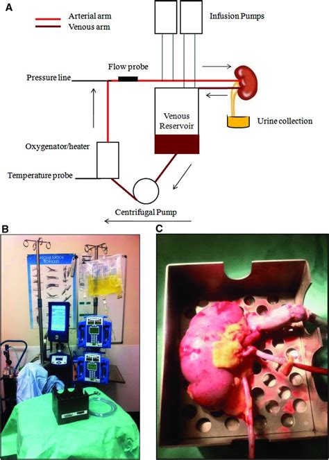 Renal Transplantation After Ex Vivo Normothermic Perfusion The First