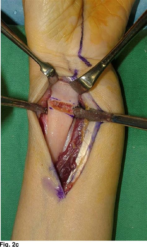 Figure 2 From Corrective Radial And Ulnar Osteotomies For Distal Radial