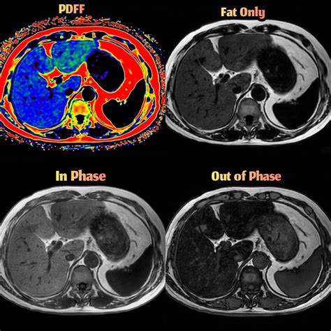 Advanced Mri On Twitter Non Invasive Liver Fat Quantification Mdixon Quant Brings A Fast And