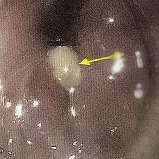 Pus draining from site of perforation. | Download Scientific Diagram