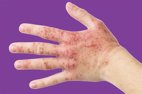 Hand eczema | Eczema on Hands - Pure Medical