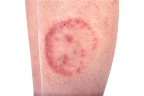 Armpit Fungus Ringworm