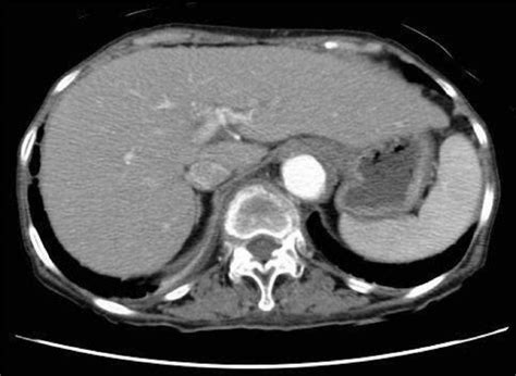 Axial Contrast Enhanced Computed Tomographic Scan Obtained On