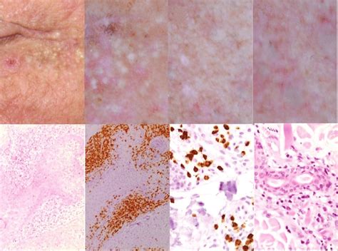 Patient No 2 Clinical And Dermoscopic Presentation Of The Lesion On