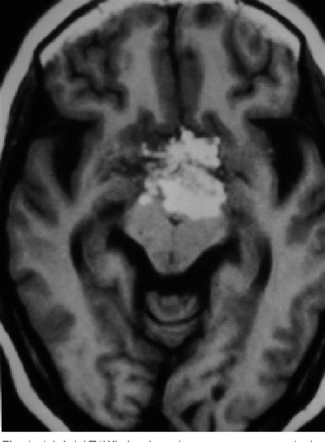 Figure 1 From Asymptomatic Spontaneous Rupture Of Suprasellar Dermoid