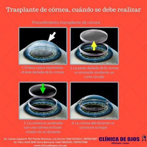 Clínica de Ojos Oftalmic Láser Trasplante de córnea cuándo se debe