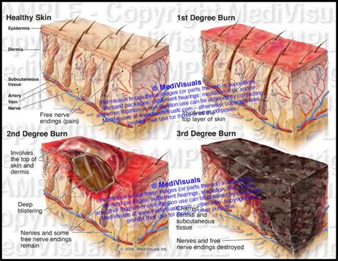 Fourth Degree Burn Diagram