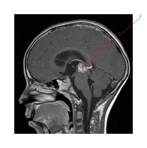 Pineal Tumors Radiology