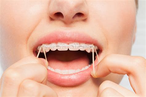 How To Use Rubber Bands For Braces Orthodontics Limited