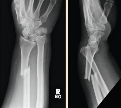 Galeazzi Fracture Dislocations | Musculoskeletal Key