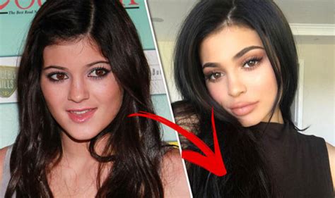 Kylie Jenner Plastic Surgery Before And After Uk