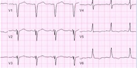 Intraventricular Conduction Defect