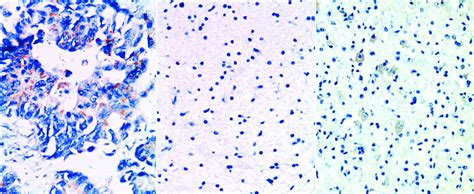 Photomicrographs Showing A Positive Control Colonic Adenocarcinoma