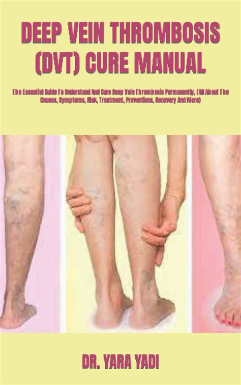 Buy Deep Vein Thrombosis Dvt Cure Manual The Essential Guide To Understand And Cure Deep Vein