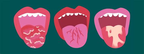 Can Psoriasis Occur in the Mouth?