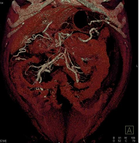 Carcinoma Head Of Pancreas With Vascular Invasion Pancreas Case