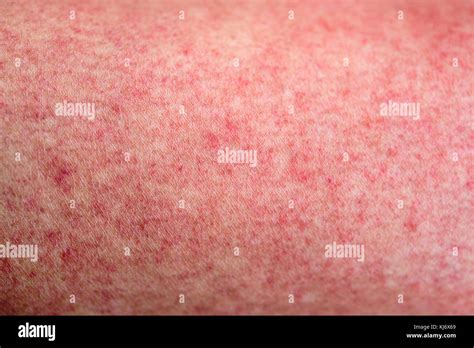 Dengue Symptoms Rash