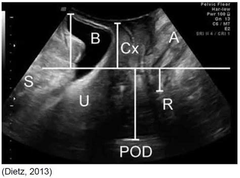 Pelvic Organ Prolapse Diagnosis With Translabial Ultrasound Gp Voice