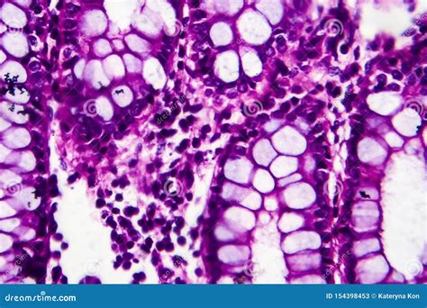 Bacillary Dysentery, Light Micrograph Stock Image - Image of hematoxylin, microphotograph: 154398453