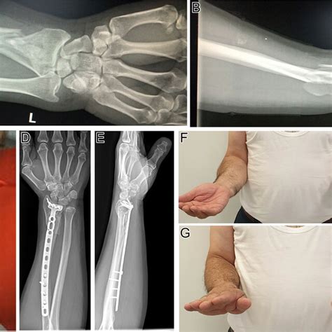 A H Gustilo Anderson Grade 2 Distal Radius Fracture With Download