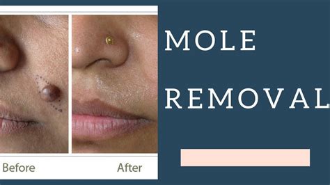 Mole Removal With Laser Dr Anvika Youtube