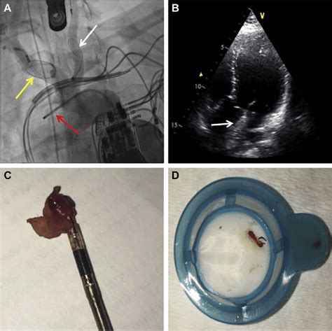 A Sentinel Cerebral Protection Device In Left Common Carotid White