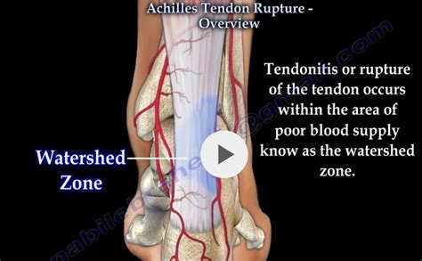 Achilles Tendon Rupture Orthopaedicprinciples