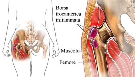 Sindrome Dolorosa Del Grande Trocantere Dott Mario Menna