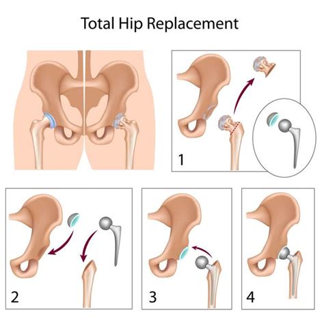 Total Hip Replacement Exercise Guidelines Dr Niraj Vora