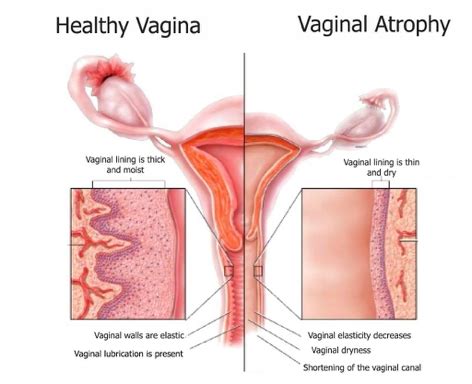 Benign Disorders Of The Vulva And Vagina Flashcards Quizlet