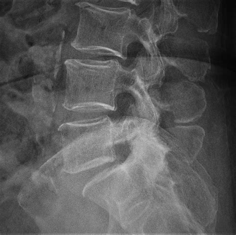 Bilateral Pedicle Fractures At Contiguous Segments In A Low JBJS