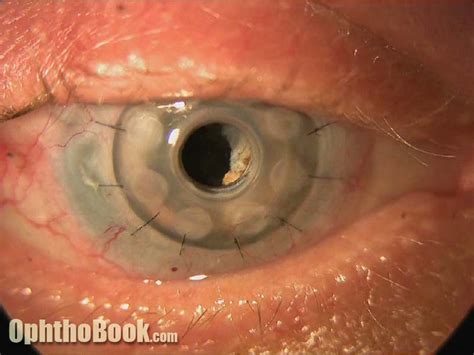 Eye Trauma Video Timroot