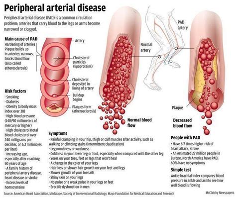 September Is Peripheral Artery Disease Awareness Month Vascular