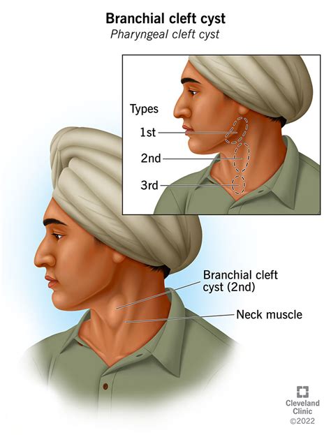 Branchial Cleft Cyst Symptoms Types And Treatment