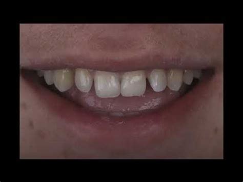 Making Class Iv Restorations Predictable Youtube