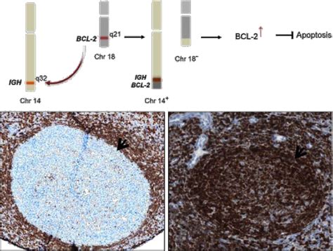 Figure From Insight Into The Pathogenesis Of Follicular Lymphoma