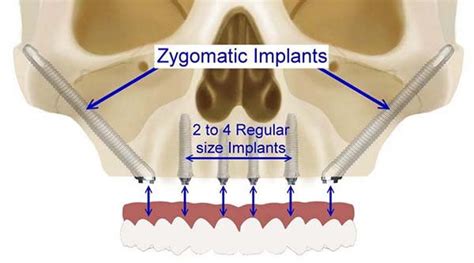 Zygomatic Dental Implant Experts G4 Precision Dental Implants