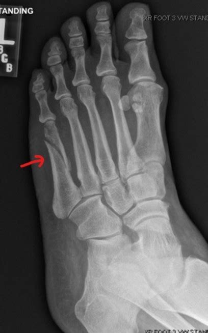 What Is A Foot Fracture? Dynamic Foot And Ankle Center, 40% OFF