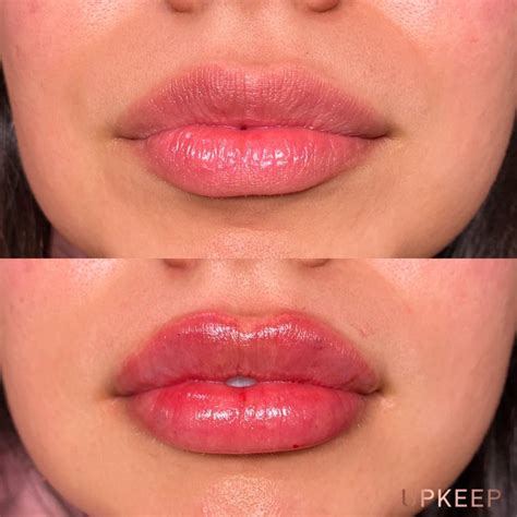 Upkeep Med Spa Injections Laser Body Contouring Aesthetics Lip Fillers Lip Plumber