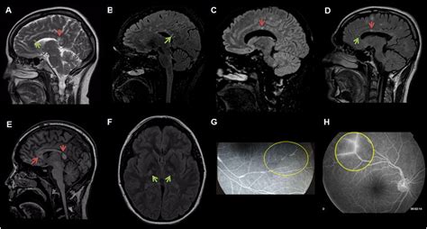 Clinical And Imaging Features Distinguishing Susac Syndrome From