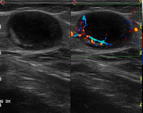 Regional Lymph Node Melanoma Metastasis To The Groin B Mode Left And Download Scientific